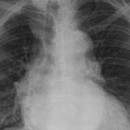 pericarditis-x-ray